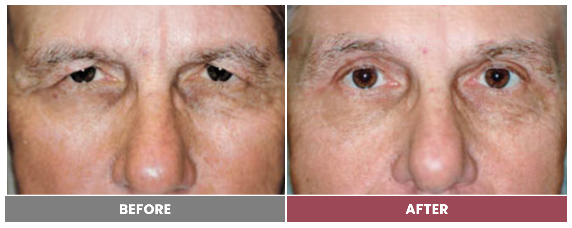 Upper Blepharoplasty - Case 68